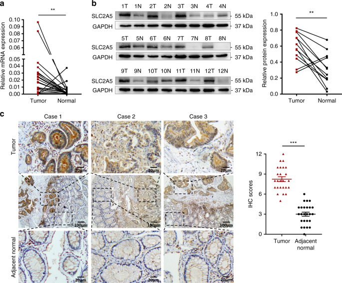 S100p Contributes To Promoter Demethylation And Transcriptional Activation Of Slc2a5 To Promote Metastasis In Colorectal Cancer British Journal Of Cancer