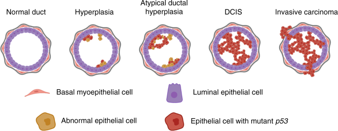 Is loss of p53 a driver of ductal carcinoma in situ progression?