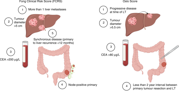 Liver transplantation in metastatic colorectal cancer: are we ready for it?  | British Journal of Cancer
