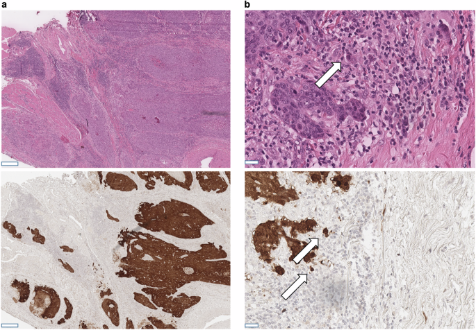 Tumor budding and lymphovascular invasion as prognostic factors in 