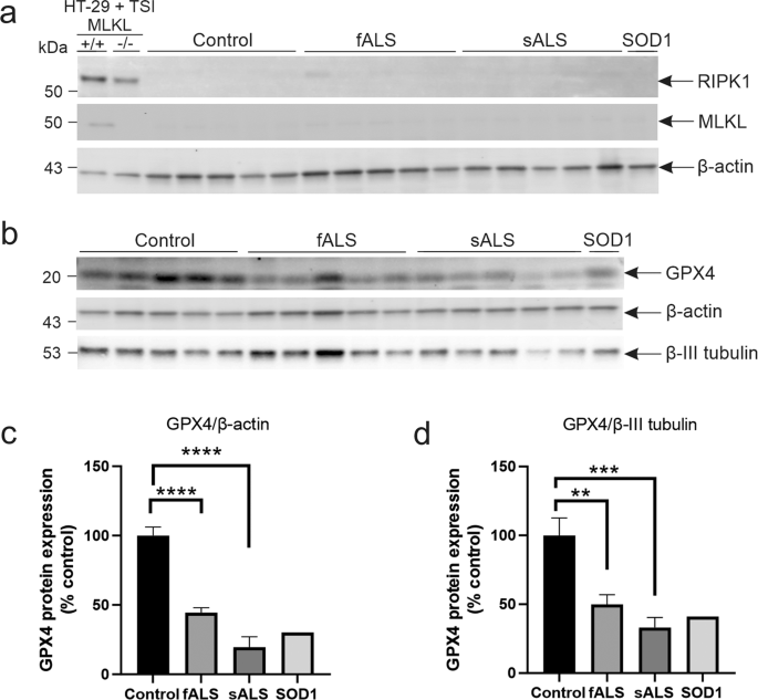 glutathione and als Impaired Synthesis in Neurodegeneration Ferroptosis mediates selective motor neuron