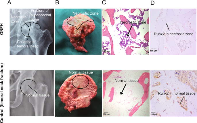 CD41-deficient exosomes from non-traumatic femoral head necrosis tissues  impair osteogenic differentiation and migration of mesenchymal stem cells |  Cell Death & Disease