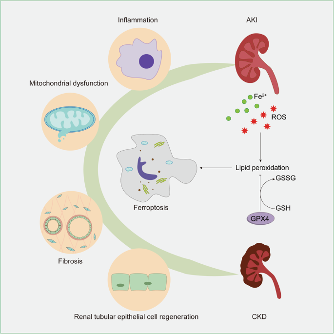 is glutathione good for ckd The Road from AKI to CKD: Molecular Mechanisms and Therapeutic Targets of  Ferroptosis
