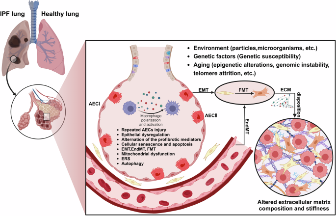 Emerging roles of noncoding RNAs in idiopathic pulmonary fibrosis ...
