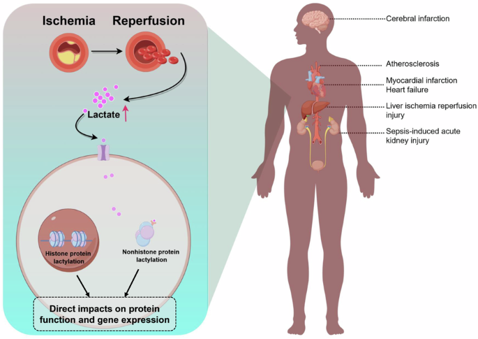 Lactylation: a promising therapeutic target in ischemia-reperfusion injury  management | Cell Death Discovery
