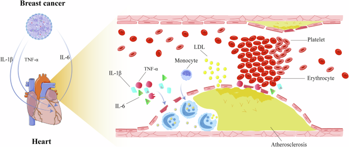 The crosstalk of breast cancer and ischemic heart disease