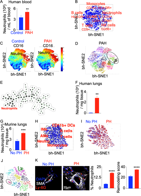 il-6 glutathione neutrophil Interleukin-6 mediates neutrophil mobilization from bone marrow in  pulmonary hypertension