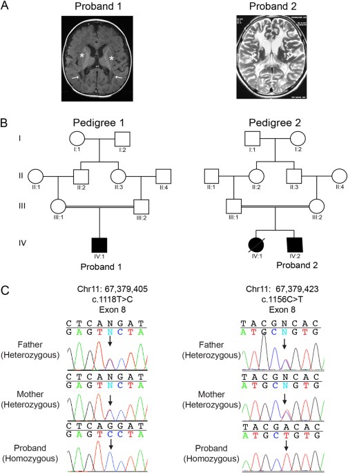 Genetic Diversity Of Ndufv1 Dependent Mitochondrial Complex I Deficiency European Journal Of Human Genetics