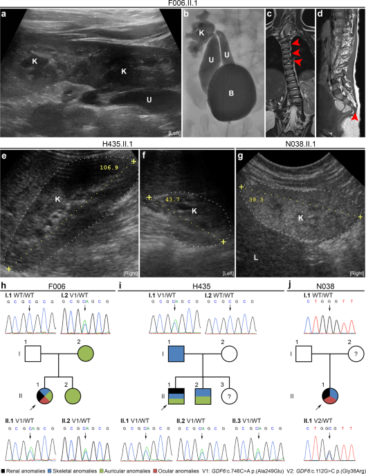 Rare heterozygous gdf6 variants in patients with renal anomalies