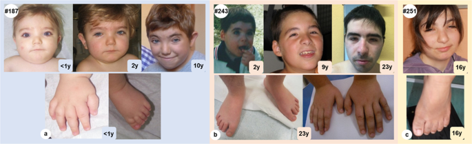 Rubinstein-Taybi syndrome: A report of two siblings with