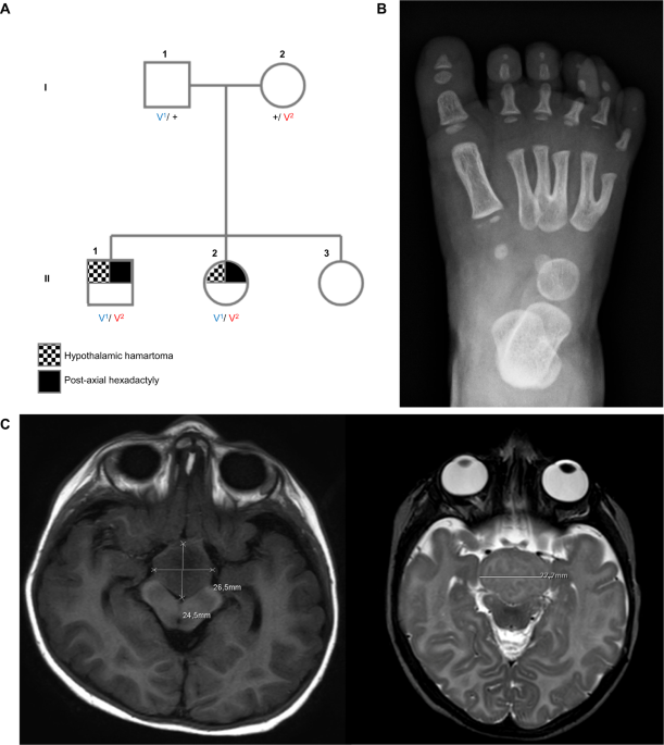 Bi-allelic SMO variants in hypothalamic hamartoma: a recessive 