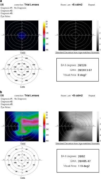 Improved retinal and visual function following panmacular Improved retinal and visual function following panmacular