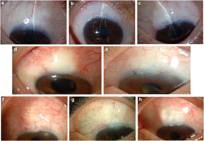 Ivermectin update