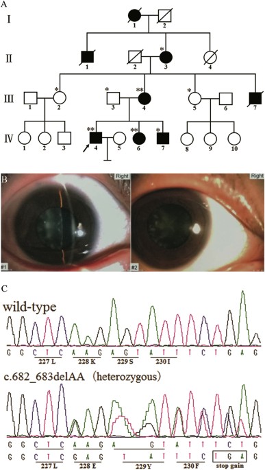 Identification Of A Novel Mip Frameshift Mutation Associated With