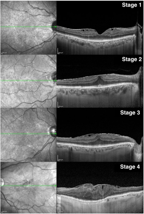 Fig 1 OCT Images Of Epiretinal Membranes Fig 1 OCT Images Of Epiretinal Membranes