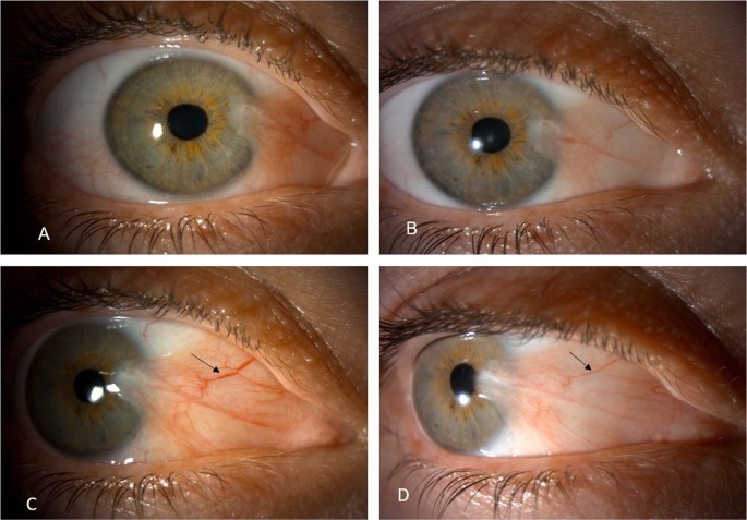 Management Of Primary Pterygium With Intra Lesional Injection Of 5 Flurouracil And Bevacizumab Avastin Eye