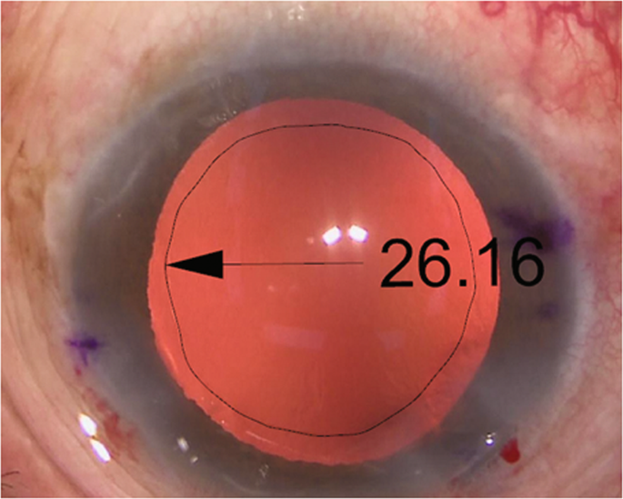 Early Postoperative Rotational Stability And Its Related Factors Of A Single Piece Acrylic Toric Intraocular Lens Eye