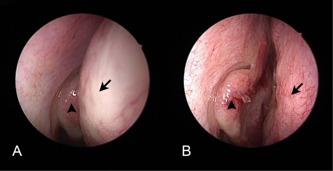 No impact of nasal septoplasty on the outcome of endoscopic  dacryocystorhinostomy