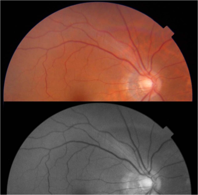 Reply to Editorial: Interpretation of OCT and fundus findings in COVID-19  patients in recent Lancet publication | Eye