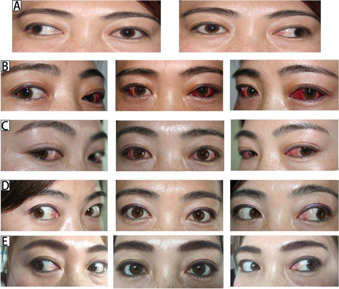 Long Term Outcomes Of Three Muscles Surgery For Very Large Angle Constant Exotropia 5 Years Of Follow Up Eye Long Term Outcomes Of Three Muscles Surgery For Very Large Angle Constant Exotropia 5 Years Of Follow Up Eye