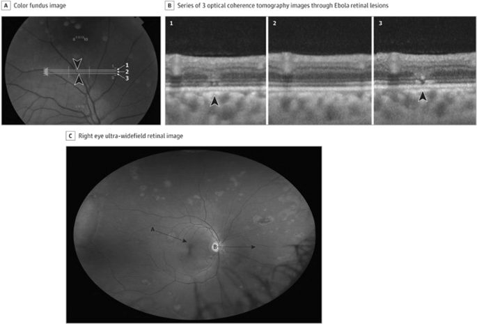 Ocular Manifestations Of Emerging Viral Diseases Eye Ocular Manifestations Of Emerging Viral Diseases Eye