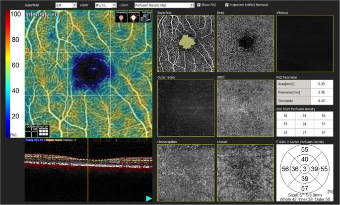 Alterations in optical coherence tomography angiography findings in patients with high myopia