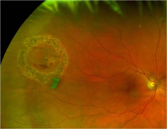 Safety and efficacy of the use of navigated retinal laser as a method of  laser retinopexy in the treatment of symptomatic retinal tears | Eye