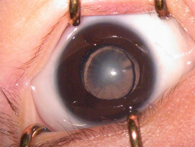 Angle Closure Glaucoma Secondary to Enlarged Soemmering Ring That is  Clinically Similar to Iris Tumour