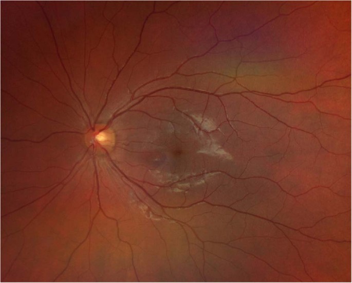 Acute macular neuroretinopathy...