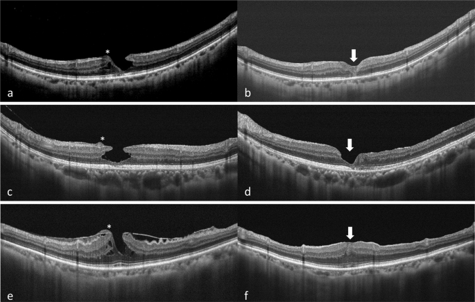 Embedding and sparing of lamellar hole–associated epiretinal proliferation  in the treatment of lamellar macular holes | Eye