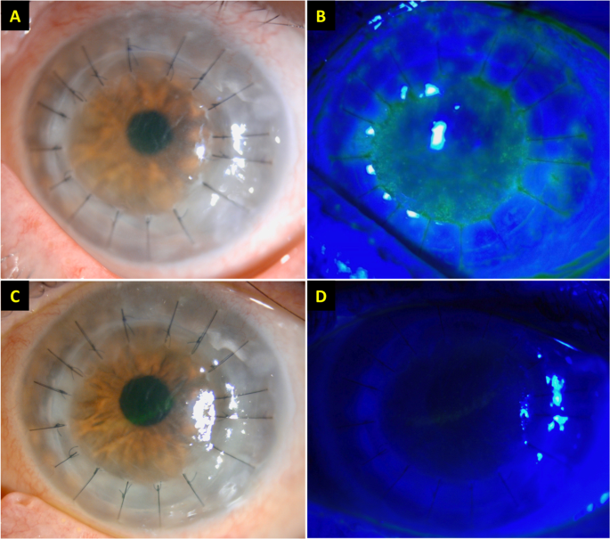Corneal graft rejection follow...
