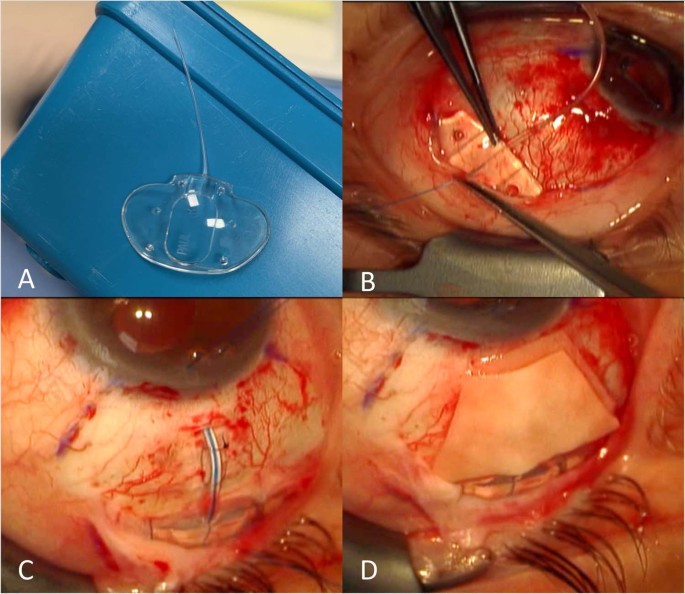 Surgical technique, perioperative management and early outcome 