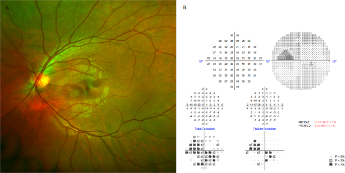 Comment on: ‘Acute macular neu...