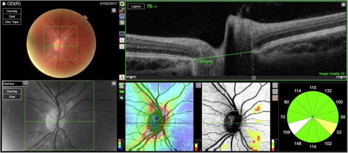Ovoid Structures Is the presence of peripapillary hyperreflective ovoid mass-like ...