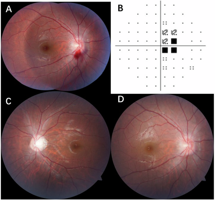 Lhon Inheritance Pattern Leber hereditary optic neuropathy with disc haemorrhage | Eye