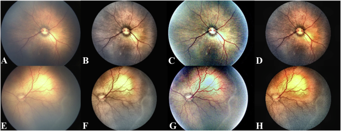 Deep learning algorithms for timely diagnosis of retinopathy of ...