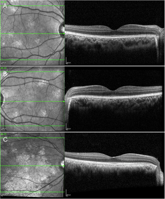 Choroidal abnormalities in neurofibromatosis type 1 | Eye