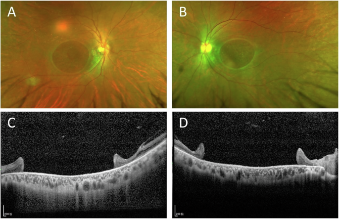 Bilateral giant macular holes in a patient with Alport syndrome | Eye