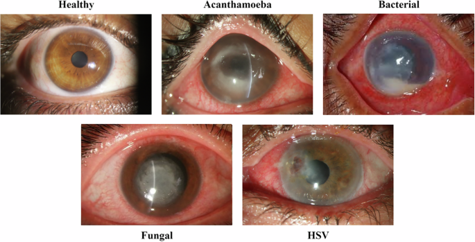 Artificial intelligence-assisted diagnosis and subtype differentiation of infectious keratitis