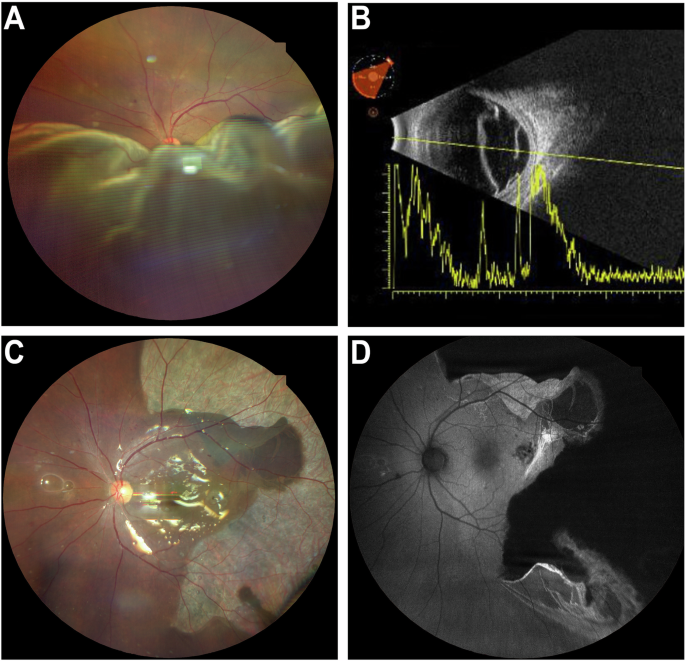 The Great unveiling: Giant RPE rip behind a bullous serous detachment