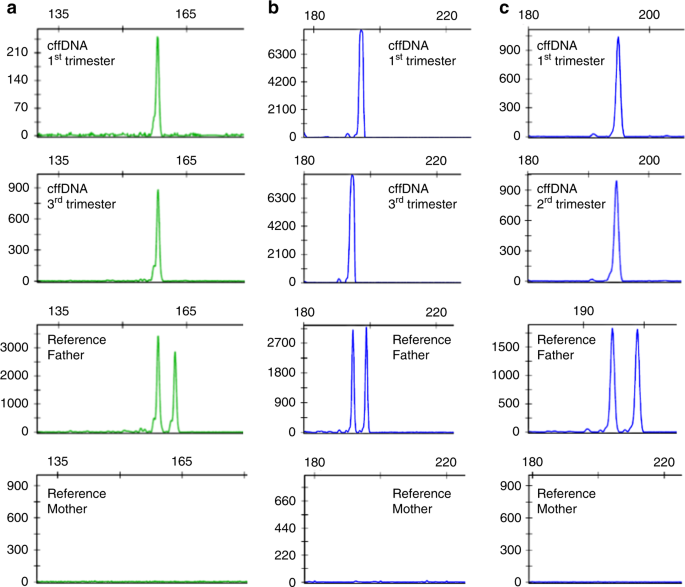 Unique Maternal Blood Dna Markers >> Analysis Of Fetal Dna In Maternal Plasma With Markers Designed For Unique Maternal Blood Dna Markers >> Analysis Of Fetal Dna In Maternal Plasma With Markers Designed For
