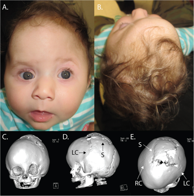 Co-occurrence of frameshift mutations in smad6 and tcf12 in a child with complex craniosynostosis