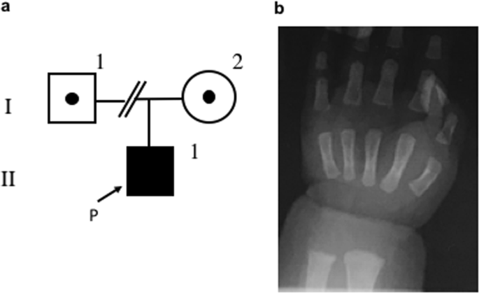 A pediatric case of hypomagnesemia 1 (homg1) caused by novel compound heterozygous mutations in trpm6