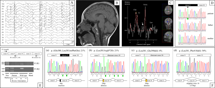 A novel splicing mutation in slc9a6 in a boy with christianson syndrome