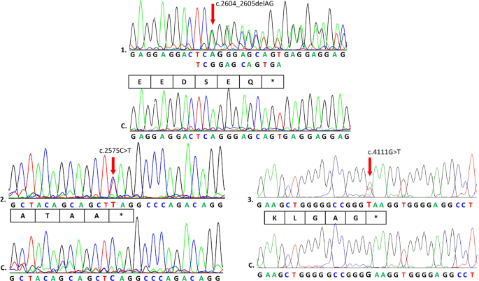 Identification of three novel TCOF1 mutations in patients with Treacher  Collins Syndrome | Human Genome Variation