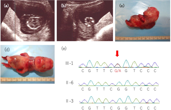 PDF) Identification of de novo EP300 and PLAU variants in a patient with  Rubinstein–Taybi syndrome-related arterial vasculopathy and skeletal anomaly