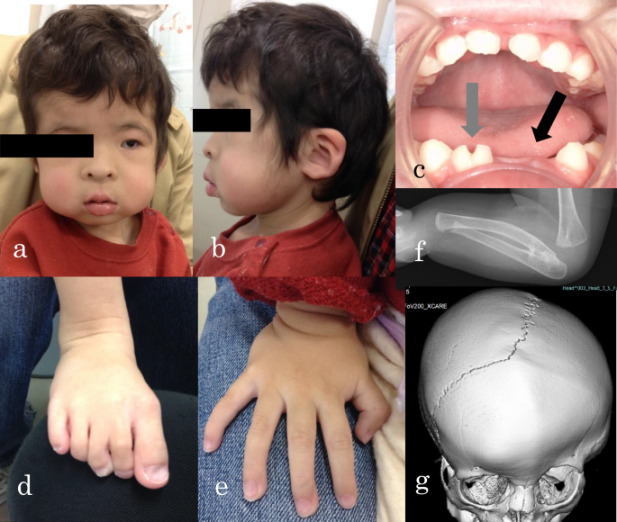 Oculofaciocardiodental syndrome caused by a novel bcor variant