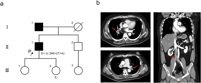 Investigation of a novel PROS1 splicing variant in a patient with ...