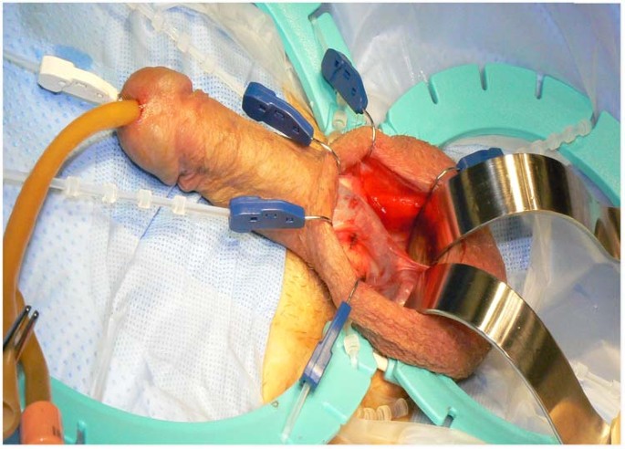 Inflatable penile prosthesis cylinders out of place during implantation |  International Journal of Impotence Research