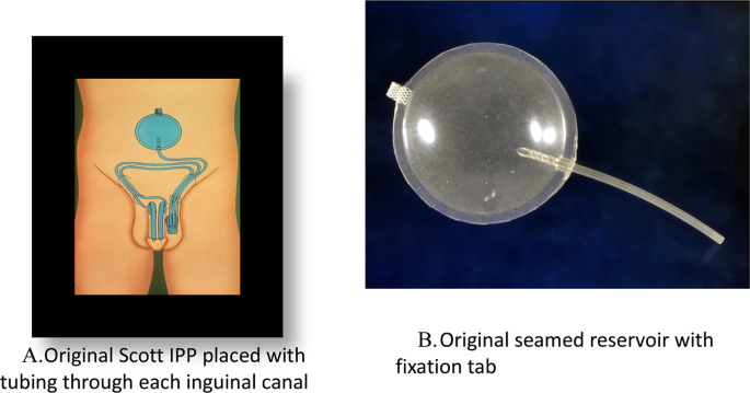 Unexpected nuances of the penoscrotal inflatable penile prosthesis |  International Journal of Impotence Research